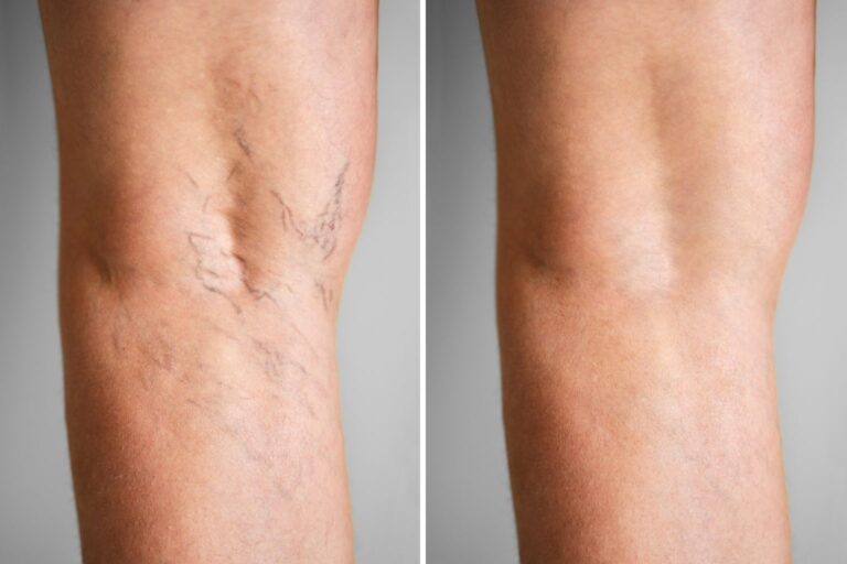 vein-disease-before-and-after-1-1536x1024-1.jpeg