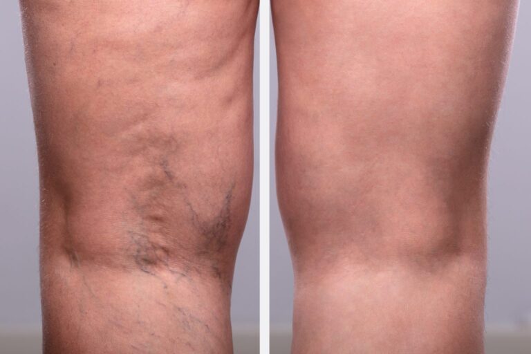 vein-disease-before-and-after-2-1536x1024-1.jpeg
