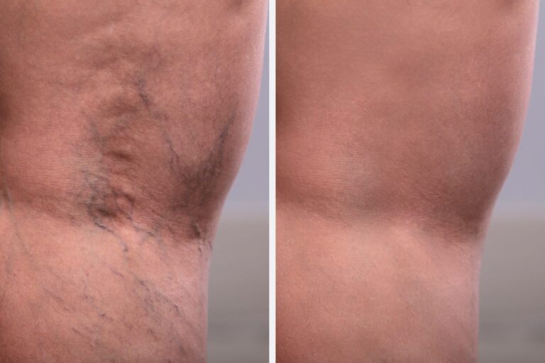 vein-disease-before-and-after-3-1536x1024-1.jpeg